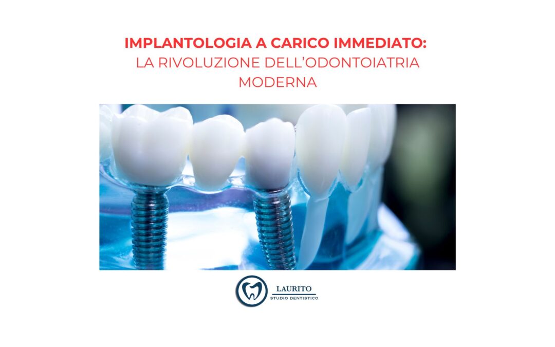 Implantologia a Carico Immediato: La Rivoluzione dell’Odontoiatria Moderna