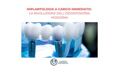 Implantologia a Carico Immediato: La Rivoluzione dell’Odontoiatria Moderna
