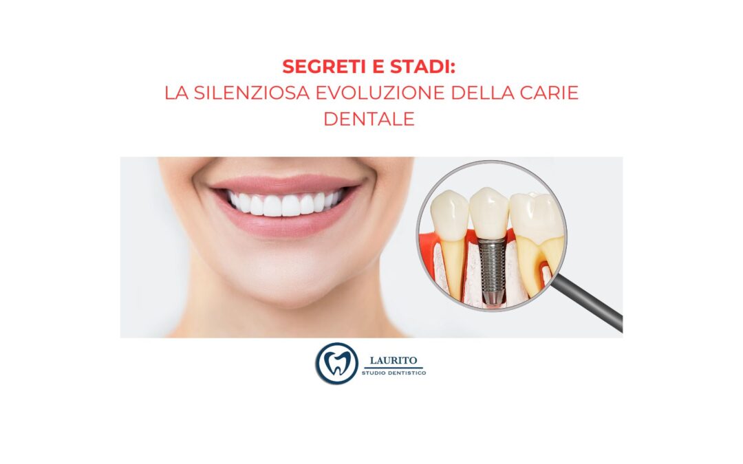 Segreti e Stadi: La Silenziosa Evoluzione della Carie Dentale