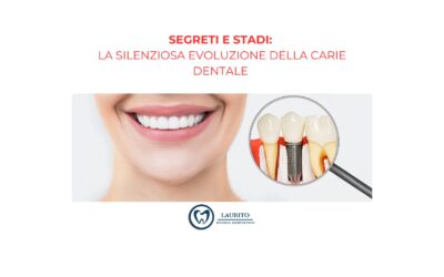 Segreti e Stadi: La Silenziosa Evoluzione della Carie Dentale
